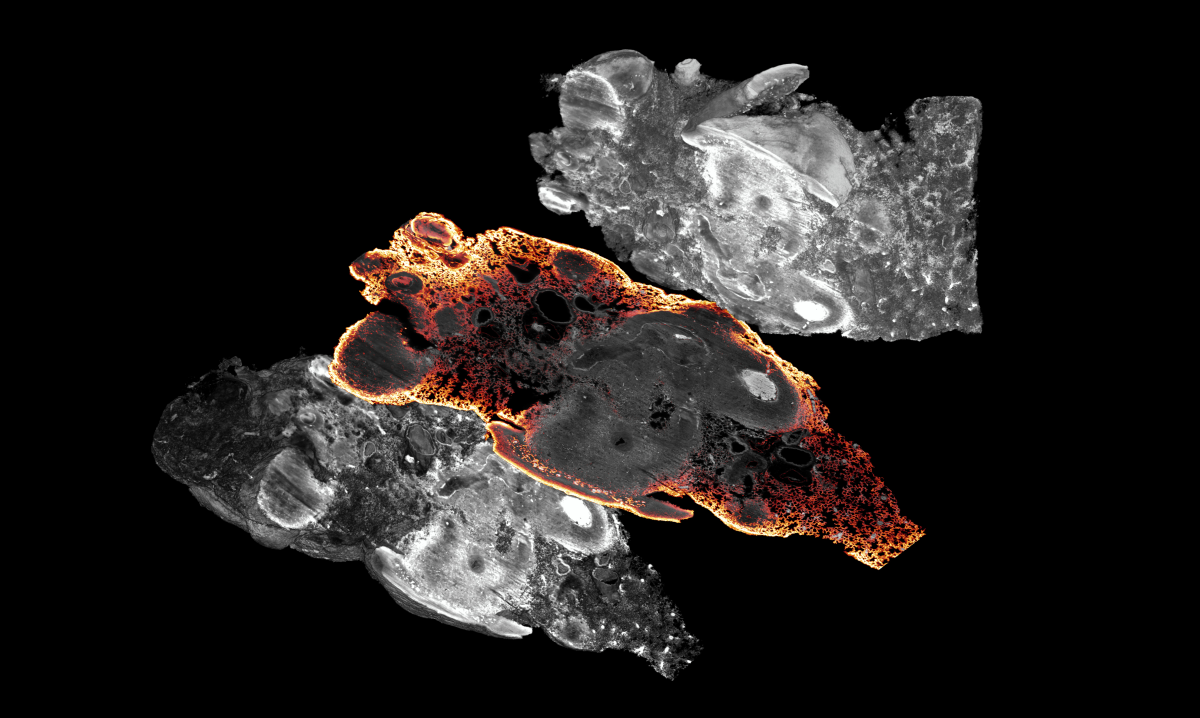 Mouse lung with metastatic osteosarcoma contained within, stained with a CD31 antibody to highlight the vasculature of the lung and around the tumor nodules.