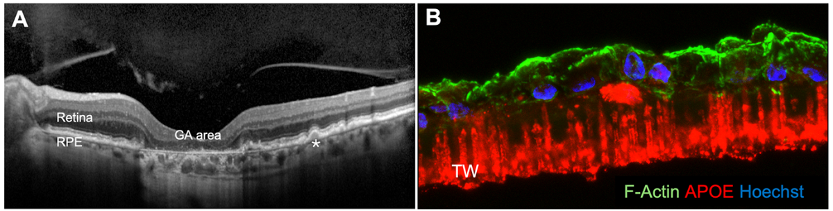 A. Optical coherence tomography image of an eye with geographic atrophy, showing loss of retinal pigment epithelium in the GA area and sub-RPE drusen deposits, including the deposit marked by an asterisk. B. Micrograph of polarized patient-derived stem cell RPE cultured on a transwell membrane and exposed to a GA-relevant stressor. APOE-positive drusen-like deposits are visible beneath the RPE, modeling key features of AMD pathology.