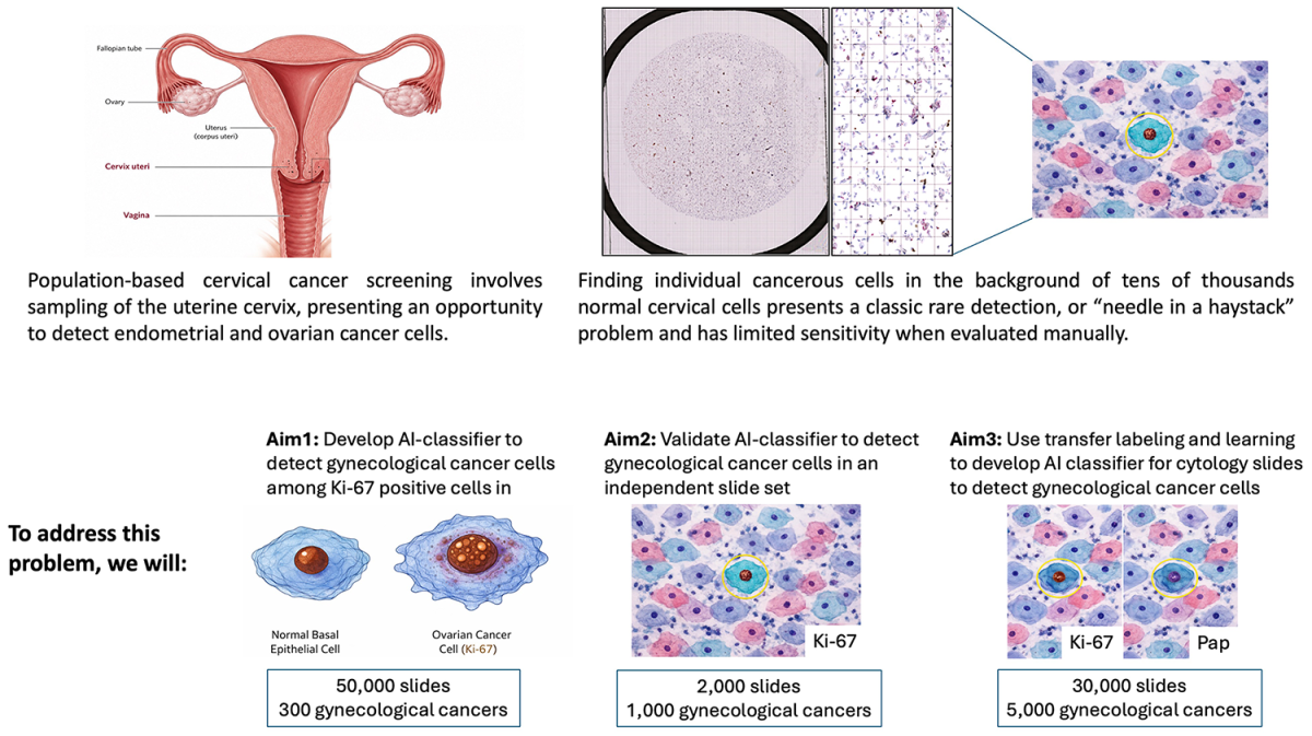 Development of an AI-based approach to identify ovarian and endometrial cancer cells in routine samples from a population-based cervical screening program.